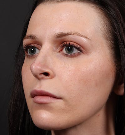 Non-Surgical Rhinoplasty Before & After Gallery - Patient 398063 - Image 2