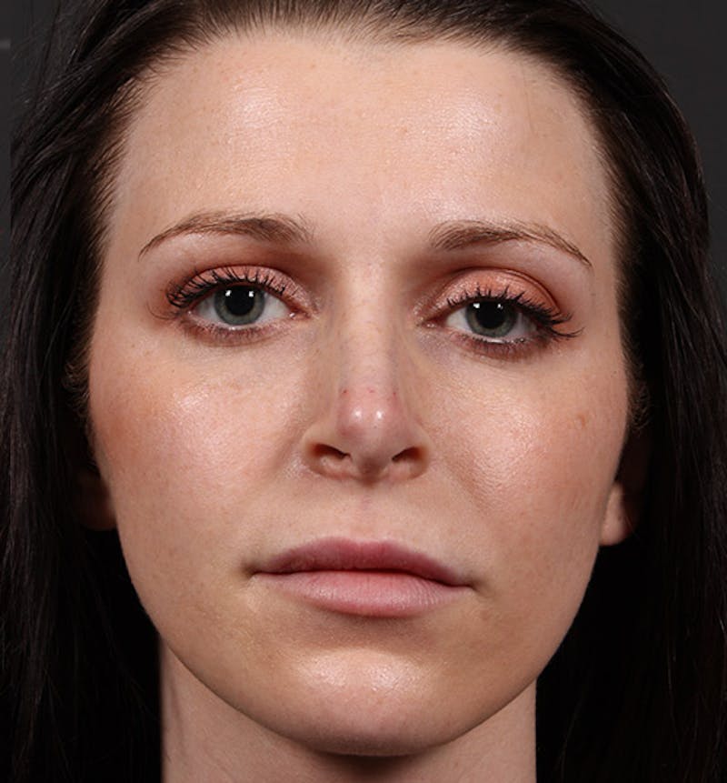 Non-Surgical Rhinoplasty Before & After Gallery - Patient 398063 - Image 4