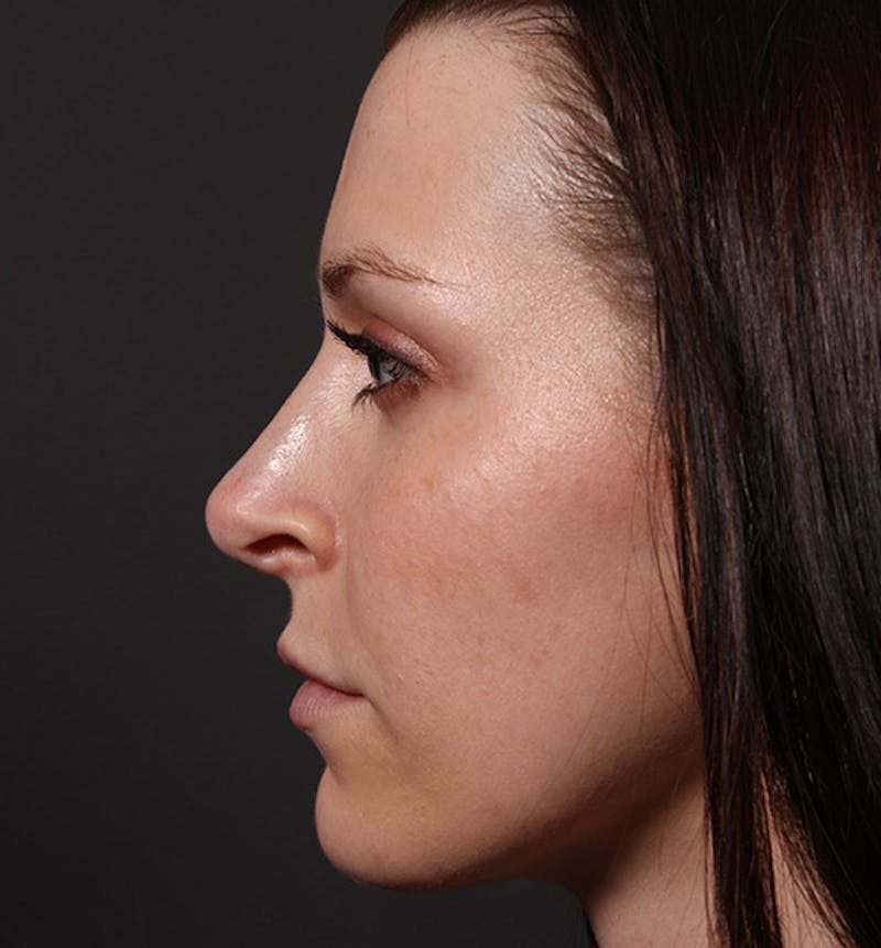 Non-Surgical Rhinoplasty Before & After Gallery - Patient 398063 - Image 5