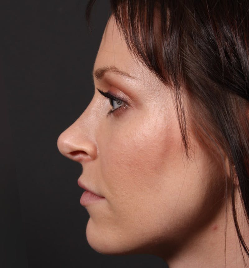 Non-Surgical Rhinoplasty Before & After Gallery - Patient 398063 - Image 6