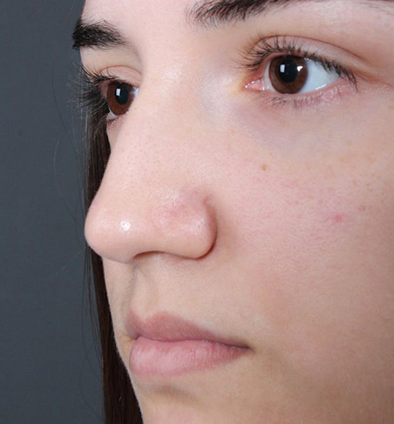 Non-Surgical Rhinoplasty Before & After Gallery - Patient 222031 - Image 1