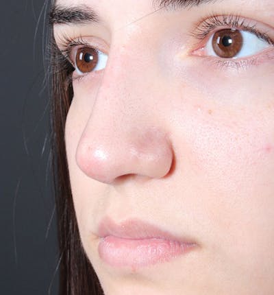 Non-Surgical Rhinoplasty Before & After Gallery - Patient 222031 - Image 2