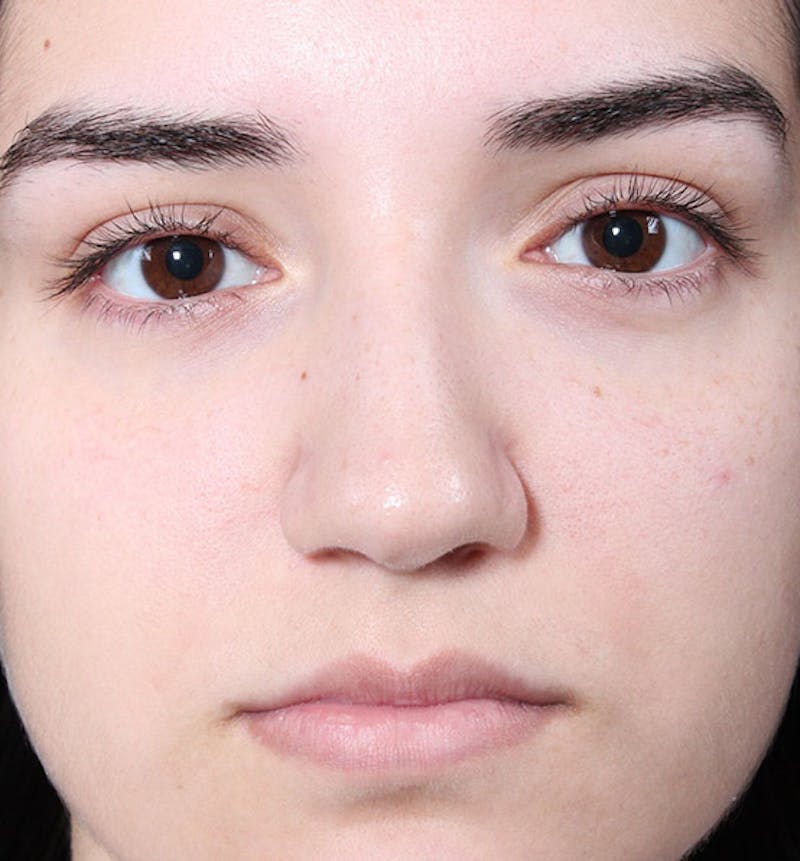 Non-Surgical Rhinoplasty Before & After Gallery - Patient 222031 - Image 3