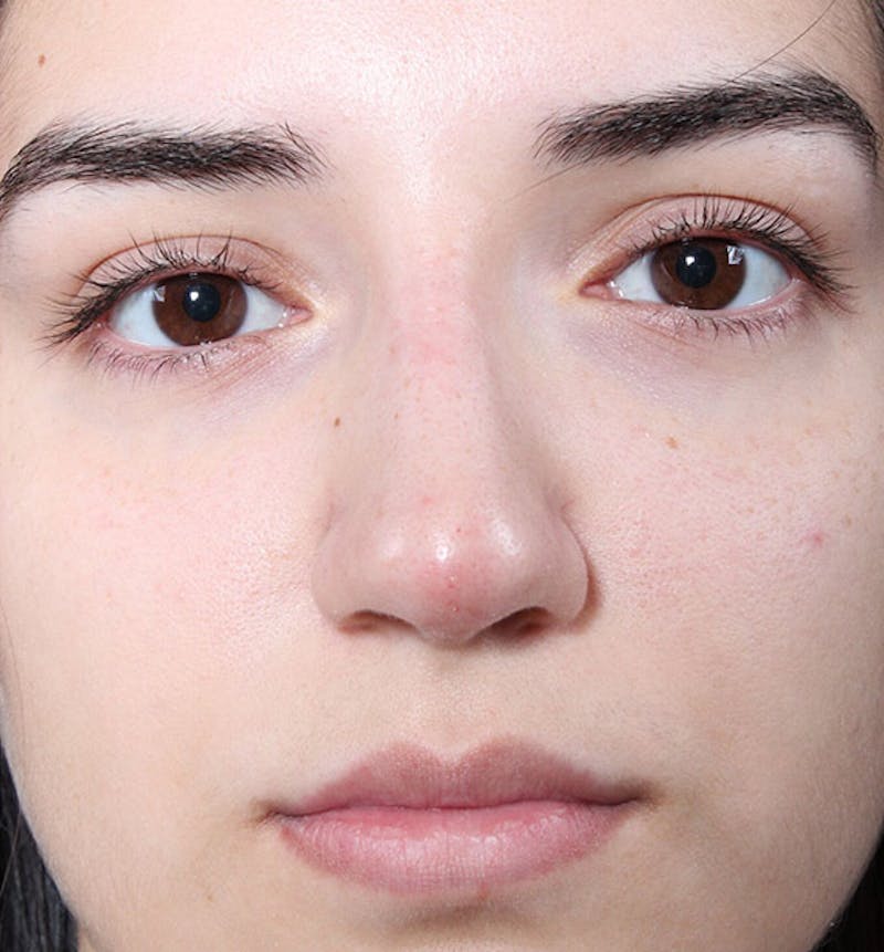 Non-Surgical Rhinoplasty Before & After Gallery - Patient 222031 - Image 4