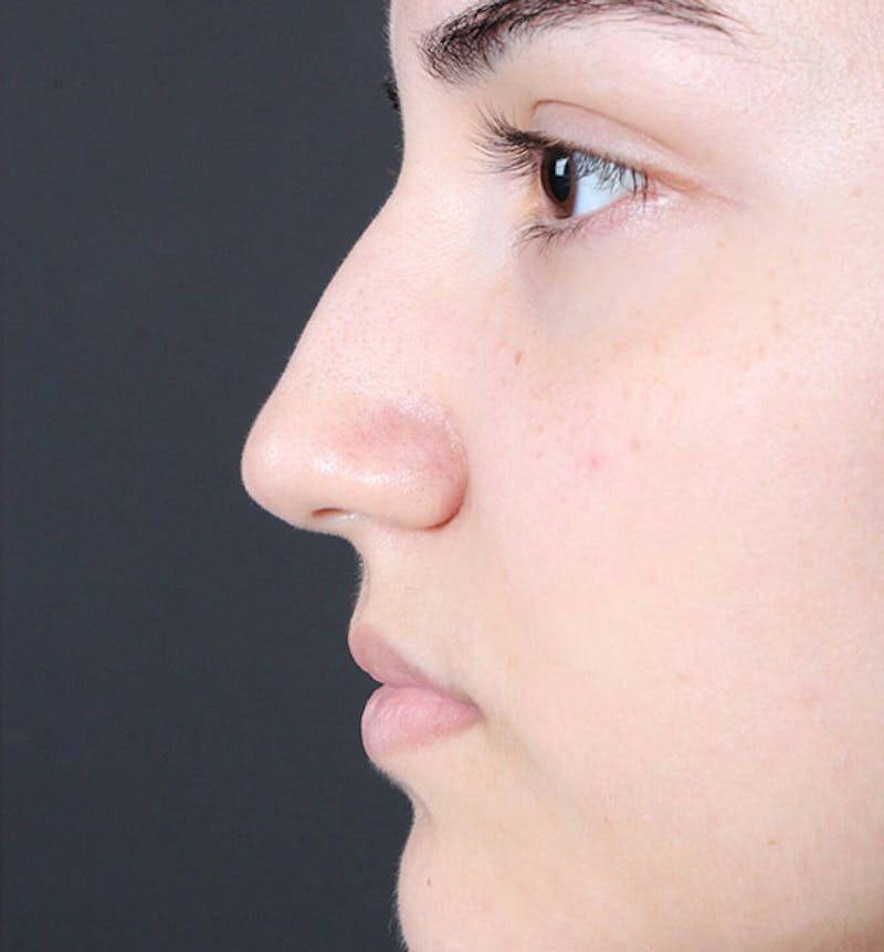 Non-Surgical Rhinoplasty Before & After Gallery - Patient 222031 - Image 5