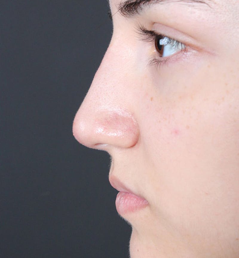 Non-Surgical Rhinoplasty Before & After Gallery - Patient 222031 - Image 6
