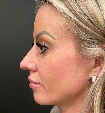 Rhinoplasty Before & After Gallery - Patient 290083 - Image 1