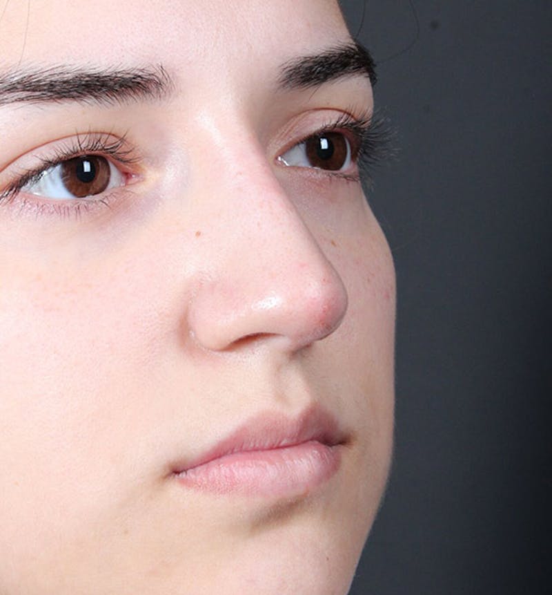 Non-Surgical Rhinoplasty Before & After Gallery - Patient 222031 - Image 8