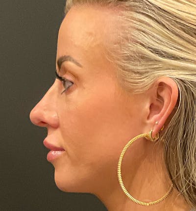 Rhinoplasty Before & After Gallery - Patient 290083 - Image 2