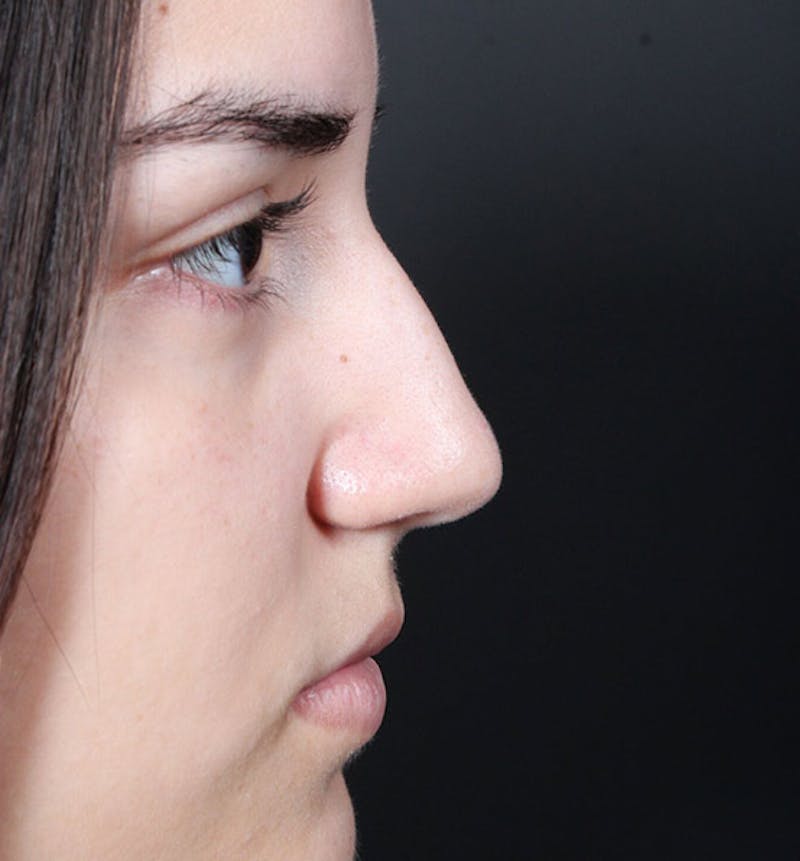 Non-Surgical Rhinoplasty Before & After Gallery - Patient 222031 - Image 9