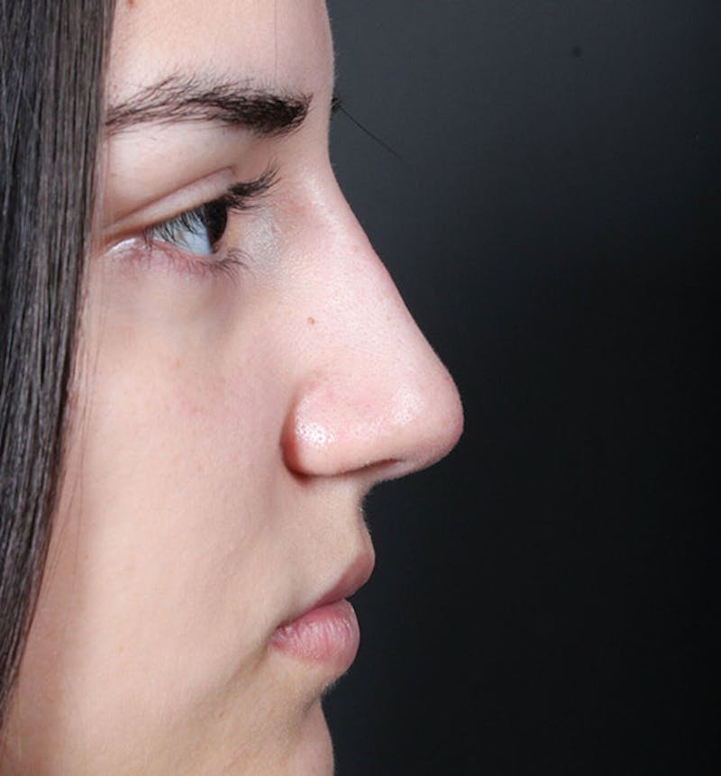 Non-Surgical Rhinoplasty Before & After Gallery - Patient 222031 - Image 10