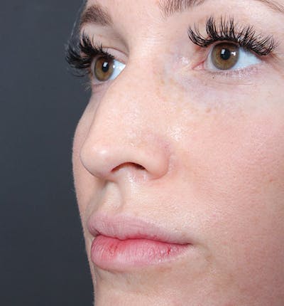Non-Surgical Rhinoplasty Before & After Gallery - Patient 295882 - Image 1