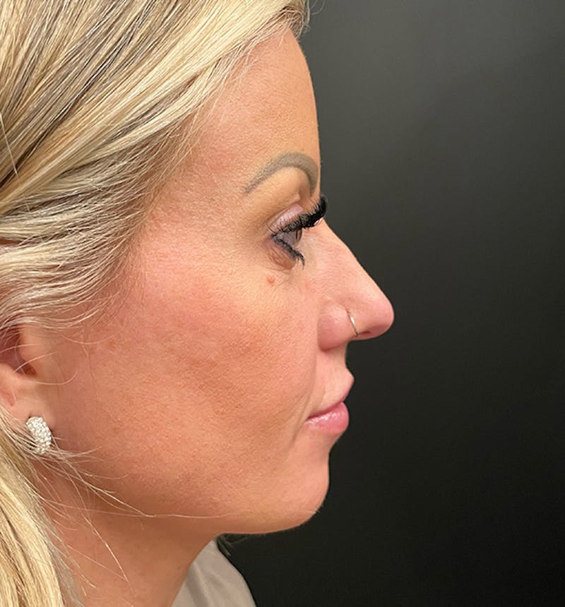 Rhinoplasty Before & After Gallery - Patient 290083 - Image 5