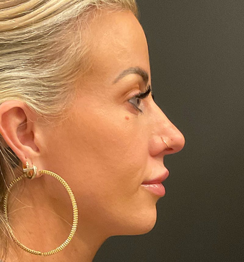 Rhinoplasty Before & After Gallery - Patient 290083 - Image 6