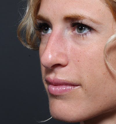 Rhinoplasty Before & After Gallery - Patient 205498 - Image 1
