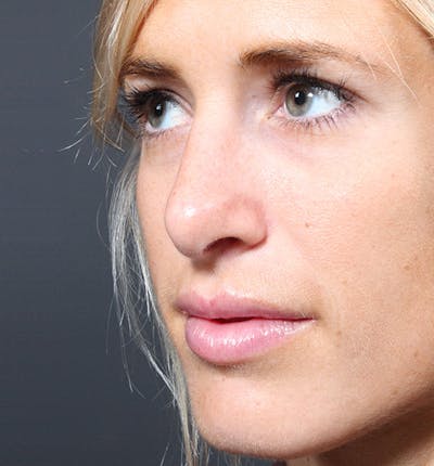Rhinoplasty Before & After Gallery - Patient 205498 - Image 2