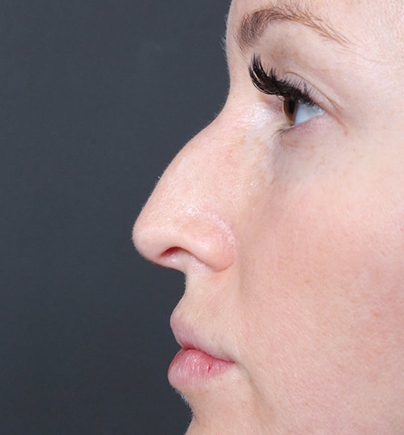 Non-Surgical Rhinoplasty Before & After Gallery - Patient 295882 - Image 5