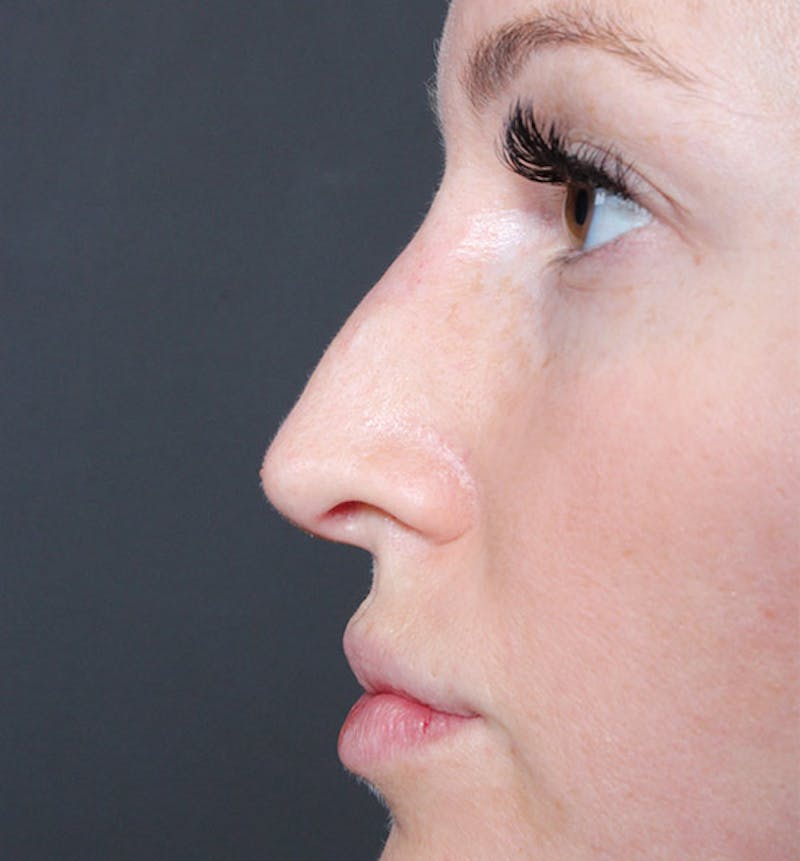 Non-Surgical Rhinoplasty Before & After Gallery - Patient 295882 - Image 6