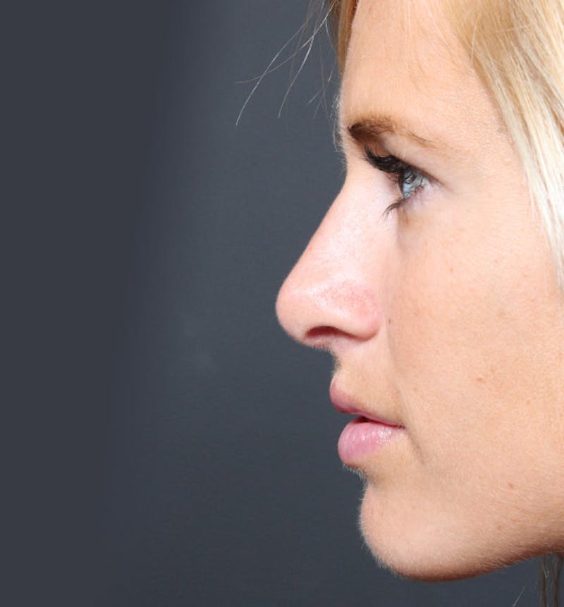 Rhinoplasty Before & After Gallery - Patient 205498 - Image 6