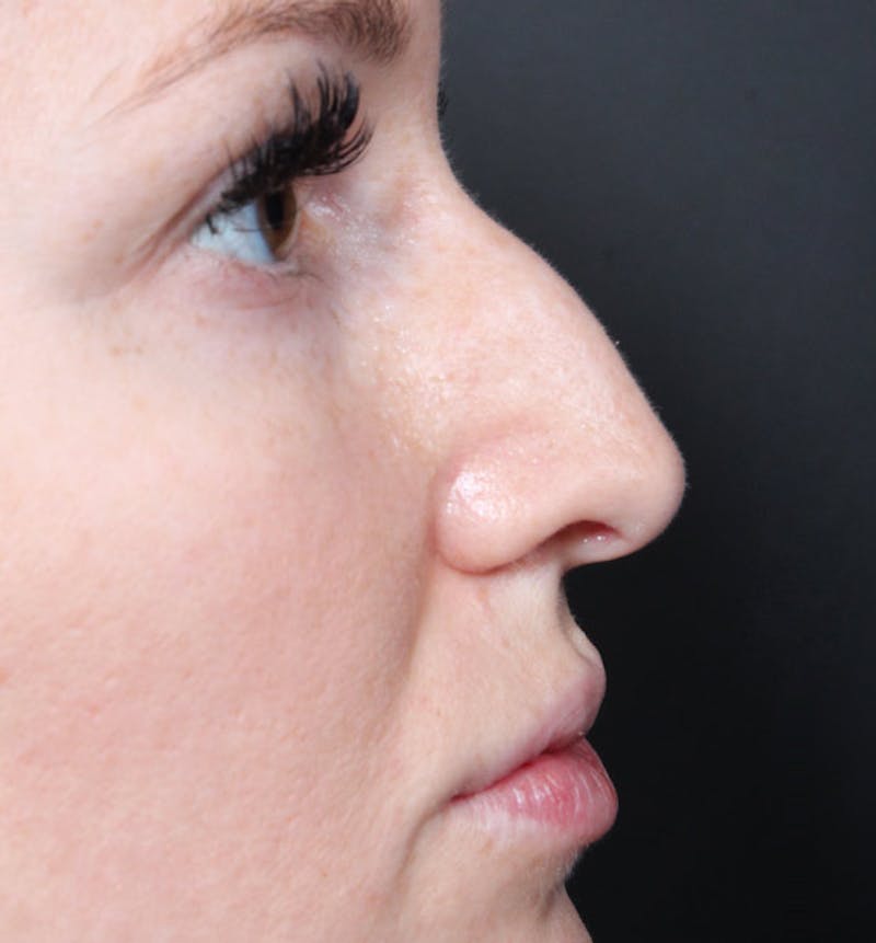 Non-Surgical Rhinoplasty Before & After Gallery - Patient 295882 - Image 9
