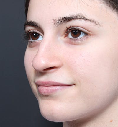 Rhinoplasty Before & After Gallery - Patient 422274 - Image 1