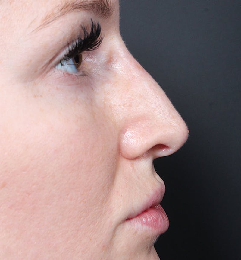 Non-Surgical Rhinoplasty Before & After Gallery - Patient 295882 - Image 10