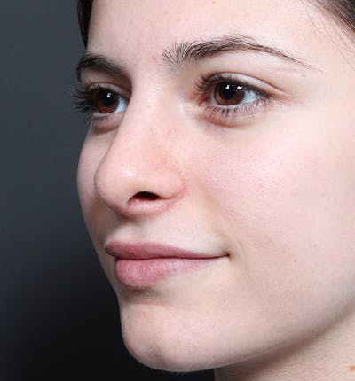 Rhinoplasty Before & After Gallery - Patient 422274 - Image 2