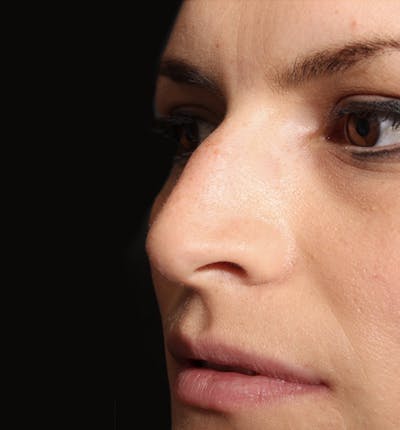 Non-Surgical Rhinoplasty Before & After Gallery - Patient 283146 - Image 1