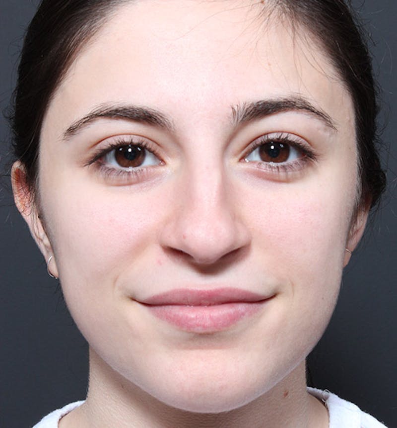 Rhinoplasty Before & After Gallery - Patient 422274 - Image 3