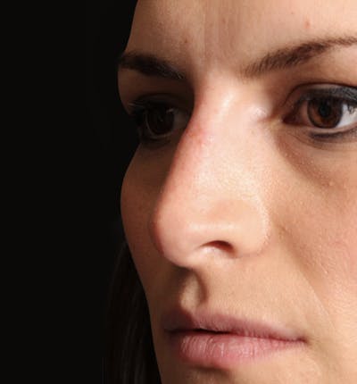 Non-Surgical Rhinoplasty Before & After Gallery - Patient 283146 - Image 2