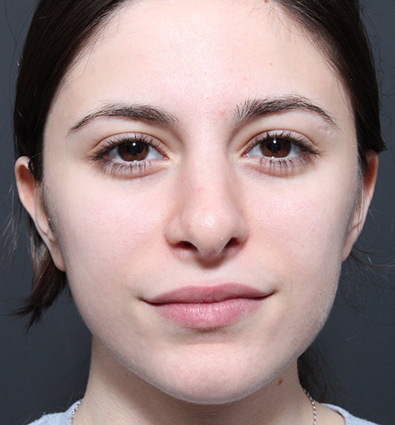 Rhinoplasty Before & After Gallery - Patient 422274 - Image 4