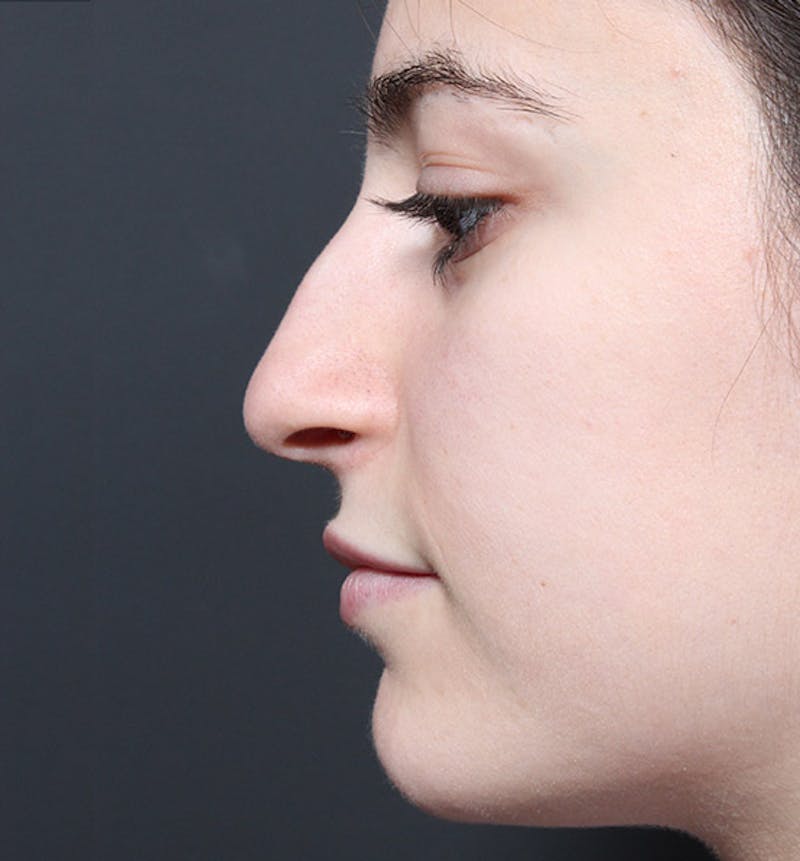Rhinoplasty Before & After Gallery - Patient 422274 - Image 5