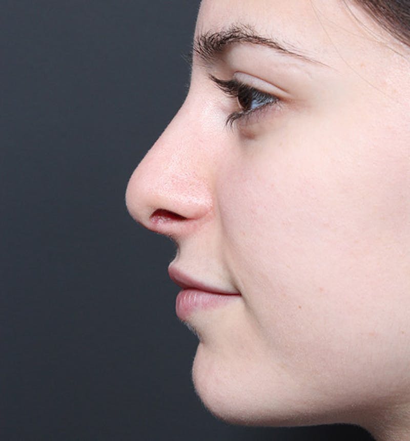 Rhinoplasty Before & After Gallery - Patient 422274 - Image 6
