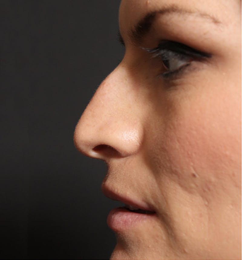 Non-Surgical Rhinoplasty Before & After Gallery - Patient 283146 - Image 5