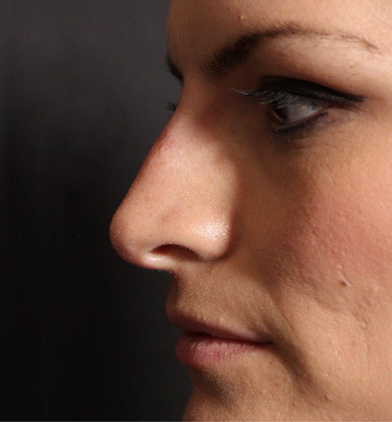 Non-Surgical Rhinoplasty Before & After Gallery - Patient 283146 - Image 6