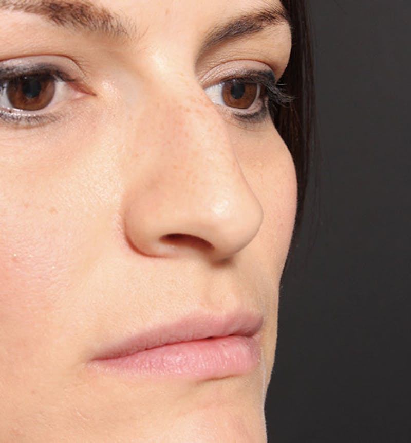 Non-Surgical Rhinoplasty Before & After Gallery - Patient 283146 - Image 7