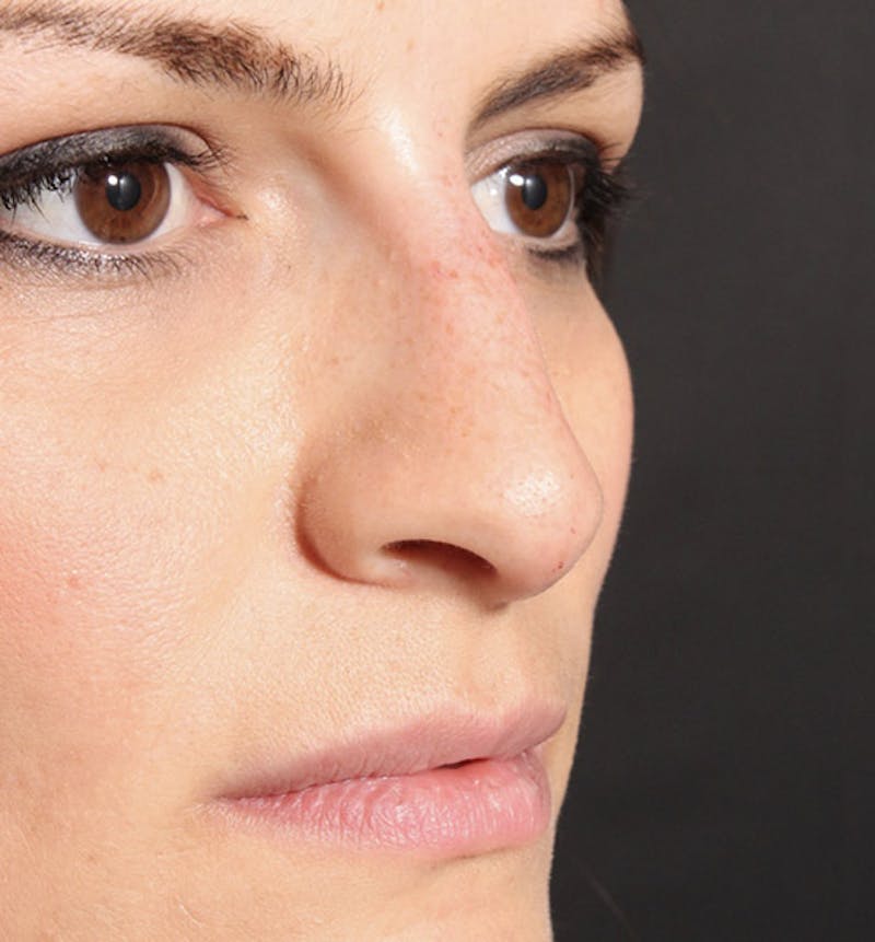 Non-Surgical Rhinoplasty Before & After Gallery - Patient 283146 - Image 8