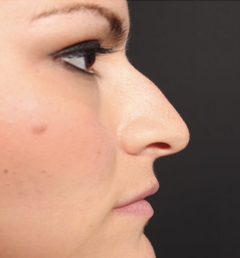 Non-Surgical Rhinoplasty Before & After Gallery - Patient 283146 - Image 9