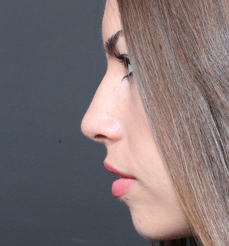 Rhinoplasty Before & After Gallery - Patient 651132 - Image 6