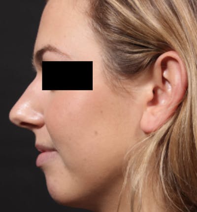 Non-Surgical Rhinoplasty Before & After Gallery - Patient 383255 - Image 1