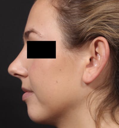 Non-Surgical Rhinoplasty Before & After Gallery - Patient 383255 - Image 2