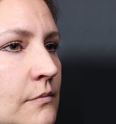 Non-Surgical Rhinoplasty Before & After Gallery - Patient 341391 - Image 1