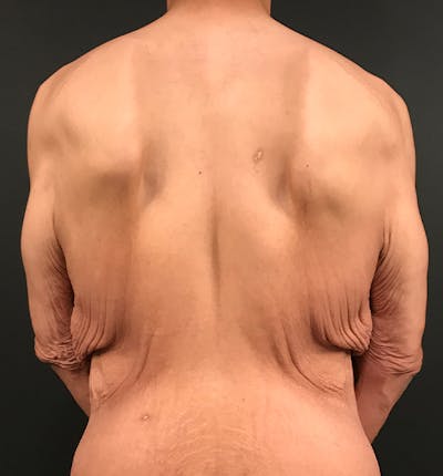 Bro Line Back Lift ™ Before & After Gallery - Patient 288459 - Image 1