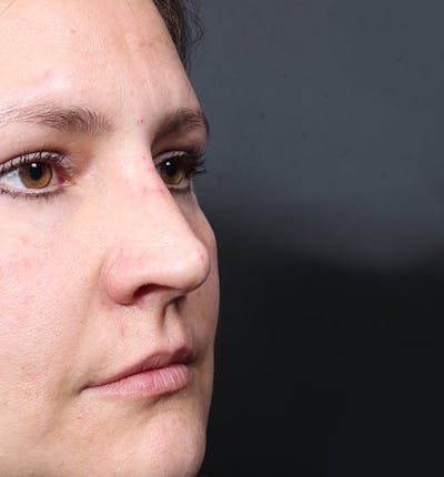 Non-Surgical Rhinoplasty Before & After Gallery - Patient 341391 - Image 2