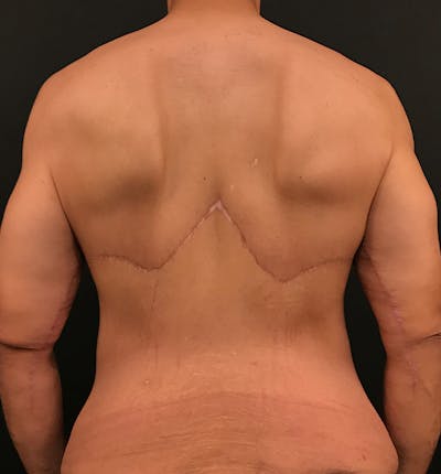 Bro Line Back Lift ™ Before & After Gallery - Patient 288459 - Image 2