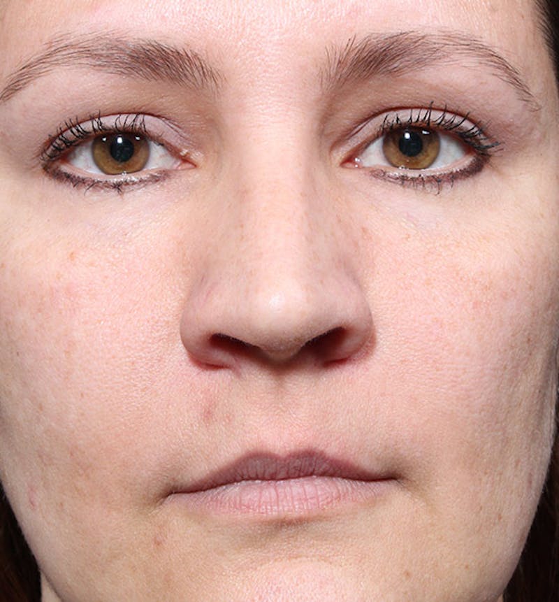 Non-Surgical Rhinoplasty Before & After Gallery - Patient 341391 - Image 3