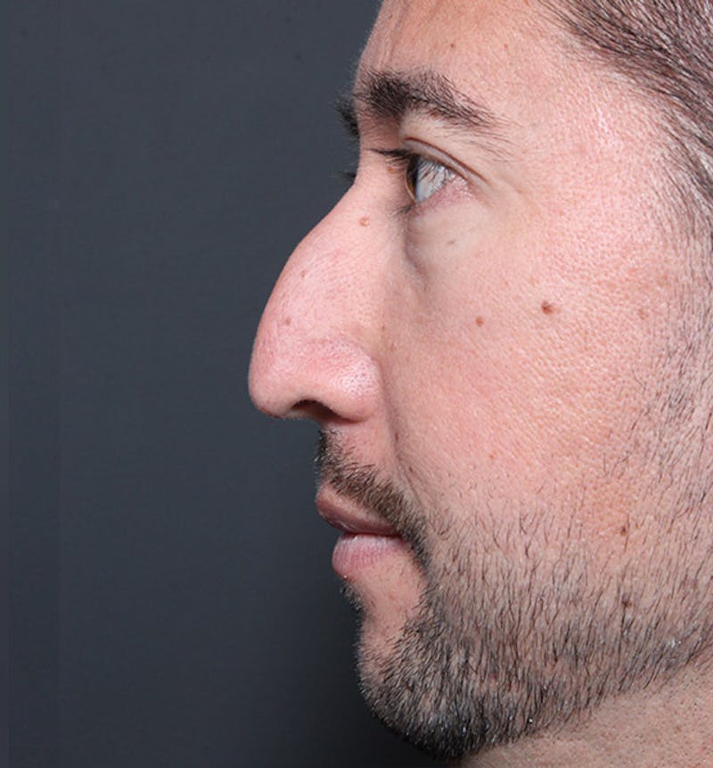 Rhinoplasty Before & After Gallery - Patient 806401 - Image 5