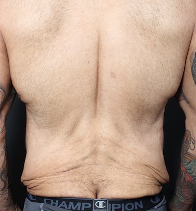 Bro Line Back Lift ™ Before & After Gallery - Patient 553814 - Image 1