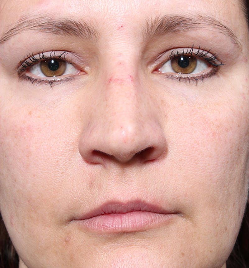 Non-Surgical Rhinoplasty Before & After Gallery - Patient 341391 - Image 4