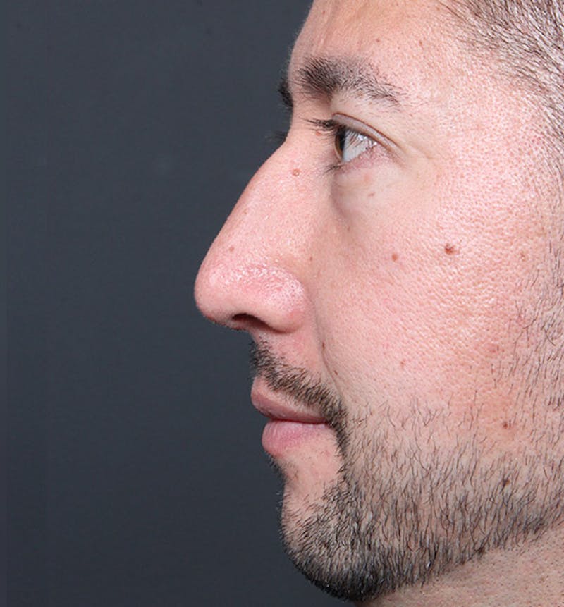 Rhinoplasty Before & After Gallery - Patient 806401 - Image 6
